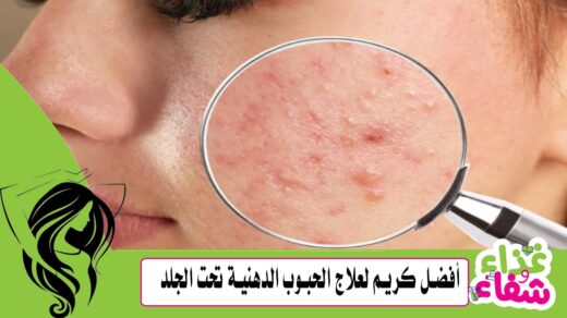 أفضل كريم لعلاج الحبوب الدهنية تحت الجلد