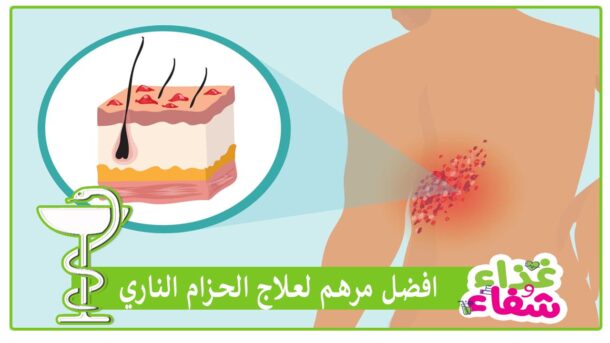 افضل مرهم لعلاج الحزام الناري varicella-zoster virus