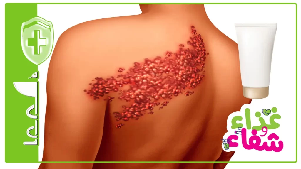 كيفية استخدام مرهم علاج الحزام الناري