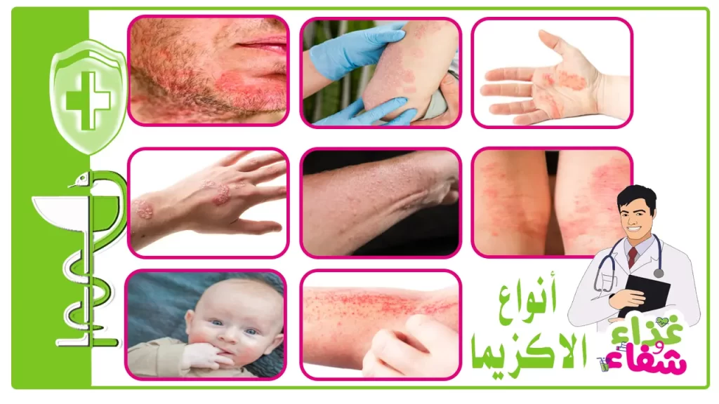 أنواع الأكزيما بالصور