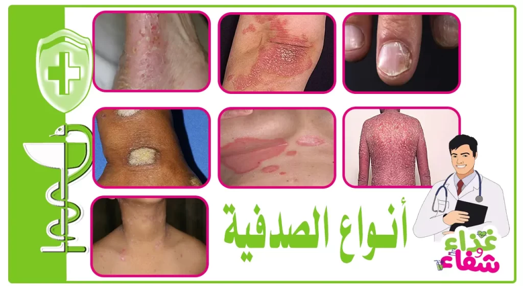 أنواع الصدفية بالصور