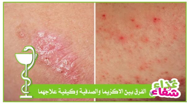 الفرق بين الاكزيما والصدفية وكيفية علاجهما