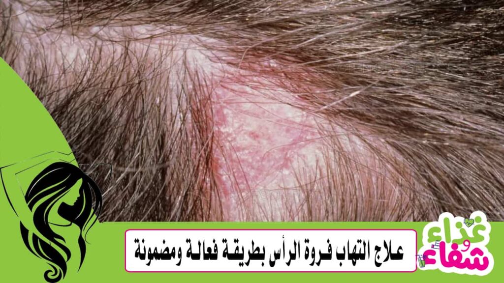 علاج التهاب فروة الرأس بطريقة فعالة ومضمونة 100%
