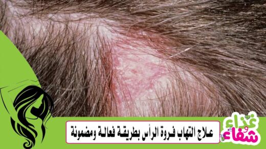 علاج التهاب فروة الرأس بطريقة فعالة ومضمونة 100%