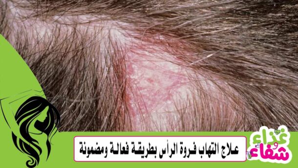 علاج التهاب فروة الرأس بطريقة فعالة ومضمونة 100%