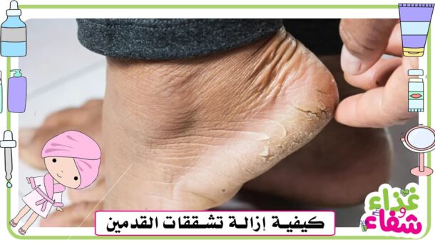 كيفية إزالة تشققات القدمين وجعلها ناعمة كالحرير