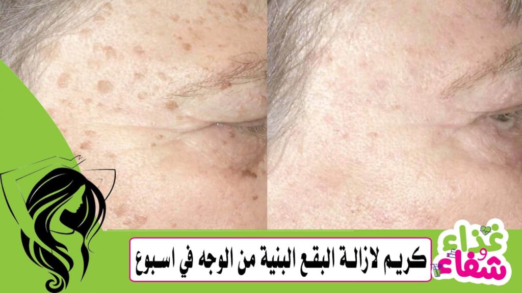 كريم لازالة البقع البنية من الوجه في اسبوع