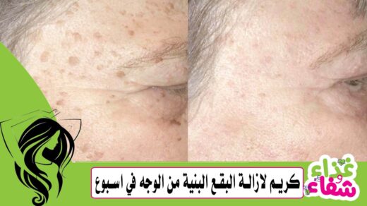 كريم لازالة البقع البنية من الوجه في اسبوع