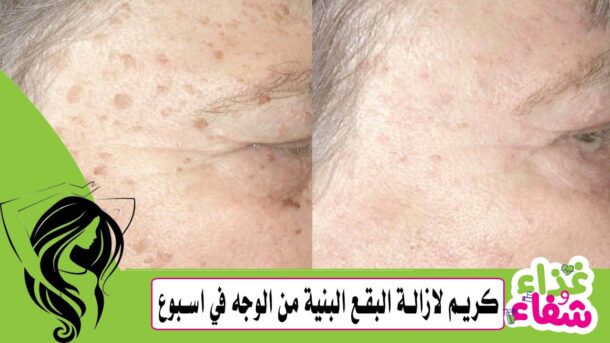 كريم لازالة البقع البنية من الوجه في اسبوع